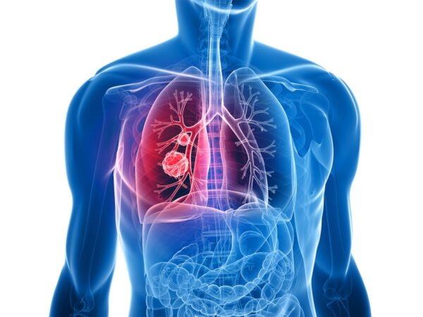 iDNA utilizes HPC services to detect lung cancer early